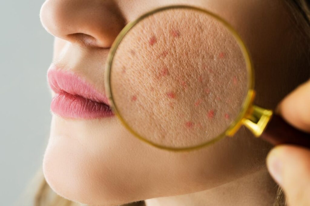Why You Still Have Acne 